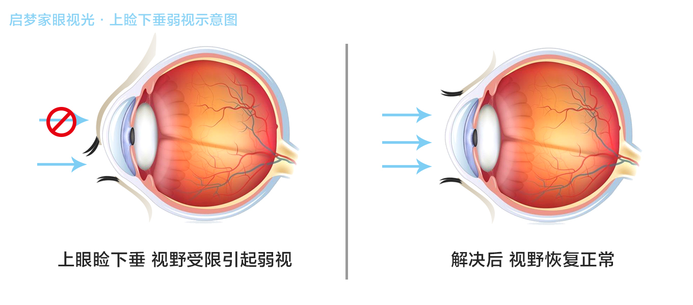 上睑下垂弱视示意图.jpg